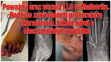 Poważny uraz ucznia I LO w Malborku. Rodzice zawiadomili prokuraturę…